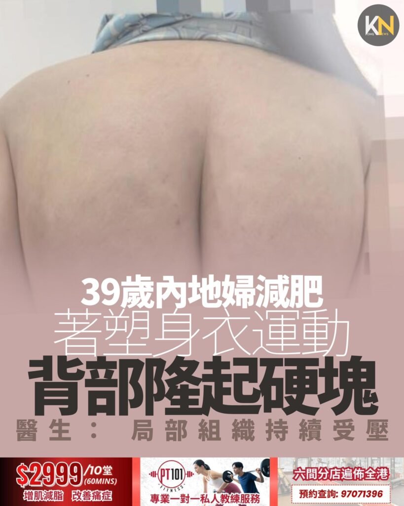 39歲內地婦減肥 著塑身衣運動 背部隆起硬塊 醫生： 局部組織持續受壓